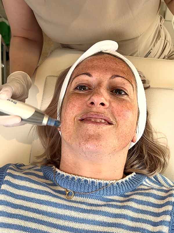 Nurse Kelsey performing Microneedling on young woman